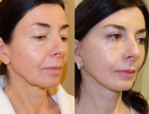 Revita Skin - rezultati - nezeljeni efekti